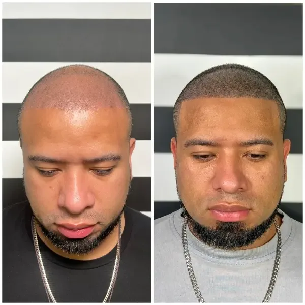SMP before and after