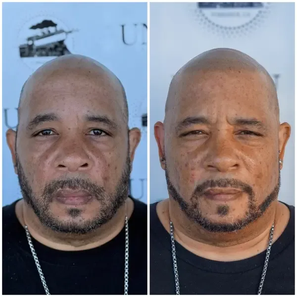 SMP before and after