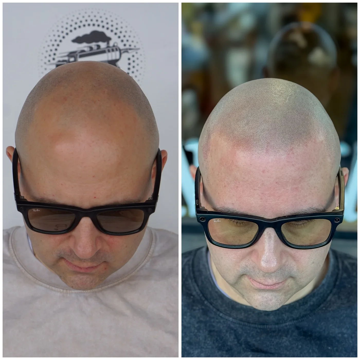 Full scalp SMP before and after