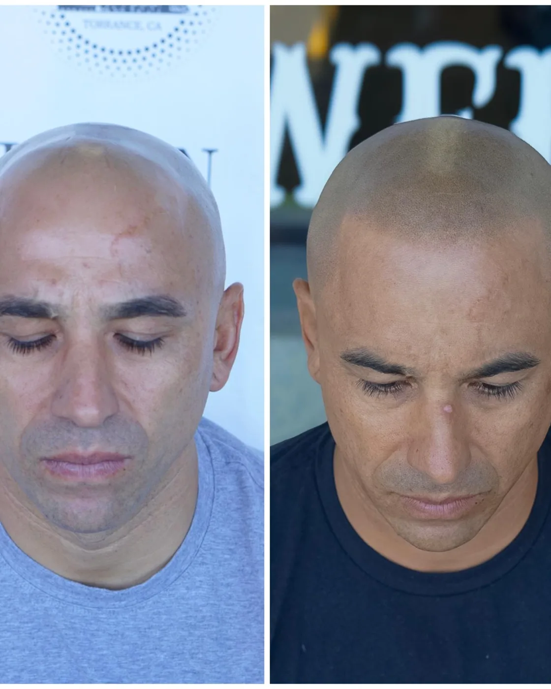 SMP before and after