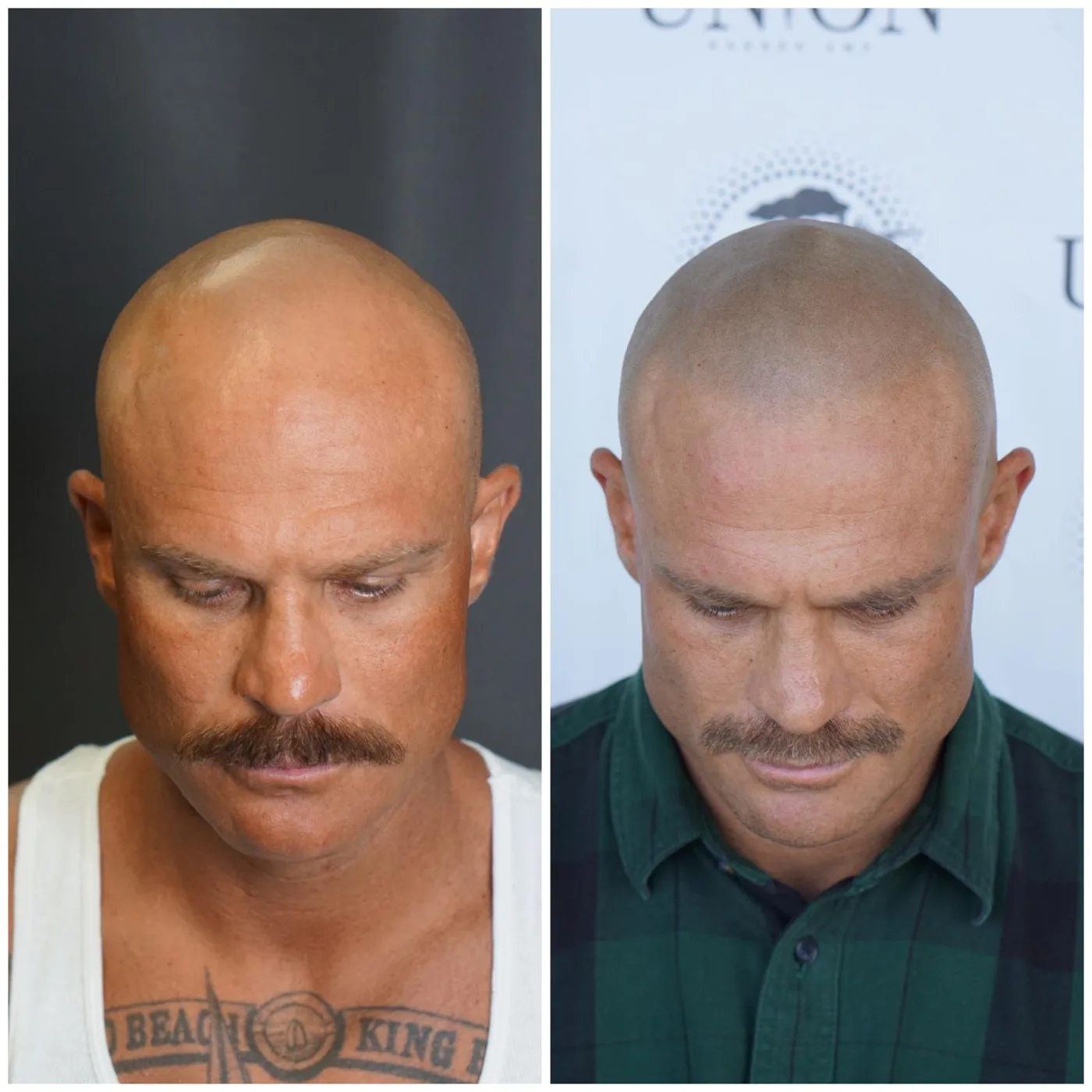 Scalp micropigmentation before and after at Union Barber SMP