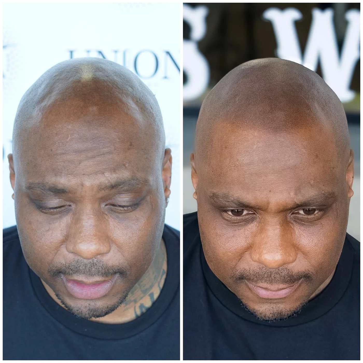SMP before and after
