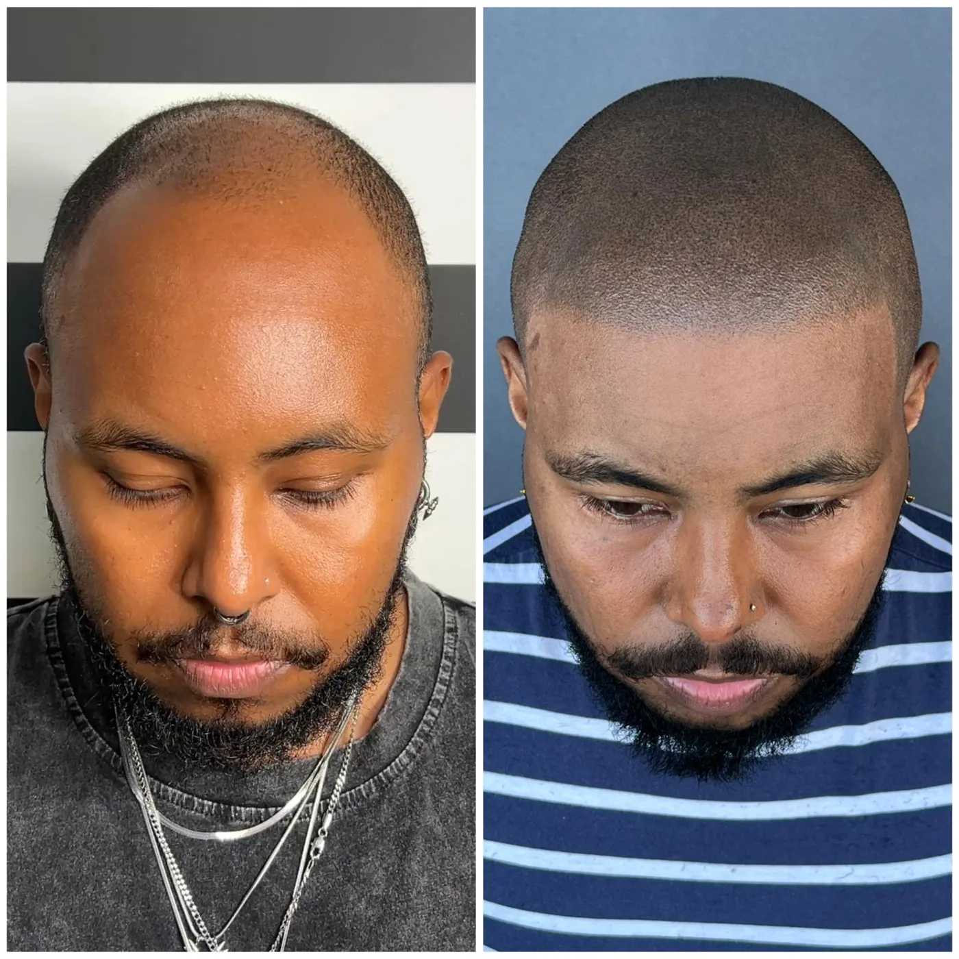 Hairline restoration before and after