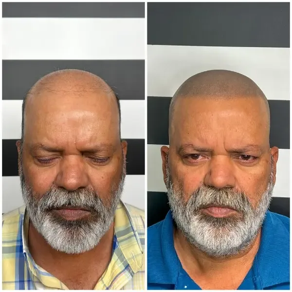 SMP before and after