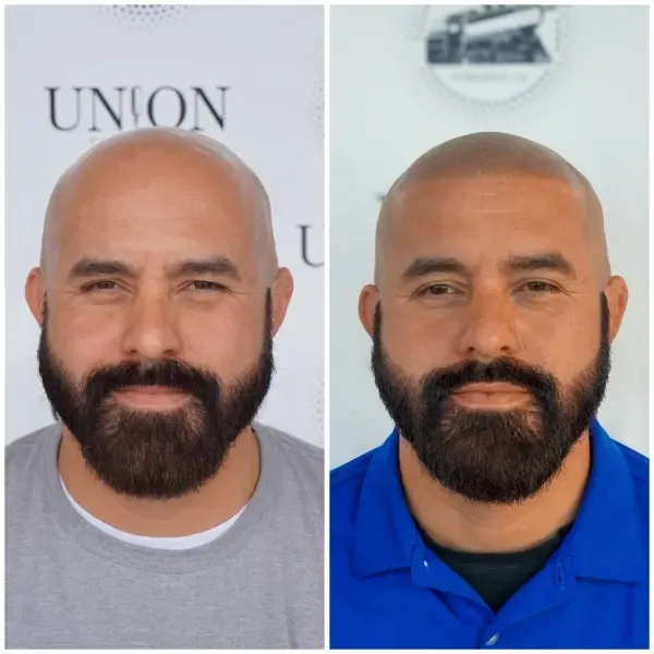 SMP before and after